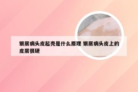 银屑病头皮起壳是什么原理 银屑病头皮上的皮屑很硬