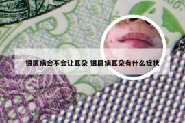 银屑病会不会让耳朵 银屑病耳朵有什么症状