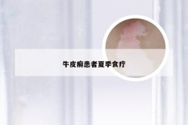 牛皮癣患者夏季食疗