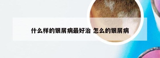 什么样的银屑病最好治 怎么的银屑病