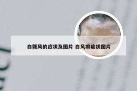 白颤风的症状及图片 白风癫症状图片
