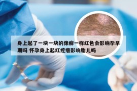 身上起了一块一块的像癣一样红色会影响孕早期吗 怀孕身上起红疙瘩影响胎儿吗