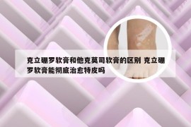 克立硼罗软膏和他克莫司软膏的区别 克立硼罗软膏能彻底治愈特皮吗