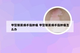 甲型银屑病手指肿痛 甲型银屑病手指肿痛怎么办
