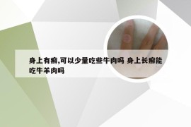 身上有癣,可以少量吃些牛肉吗 身上长癣能吃牛羊肉吗