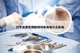 打牛皮癣生物制剂对身体有什么影响