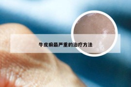 牛皮癣最严重的治疗方法