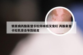 银屑病丙酸氟替卡松停掉后又变红 丙酸氟替卡松乳膏会导致蜕皮