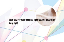银屑病治好能吃羊肉吗 银屑病治疗期间能吃牛羊肉吗