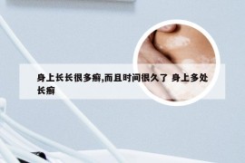 身上长长很多癣,而且时间很久了 身上多处长癣