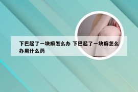 下巴起了一块癣怎么办 下巴起了一块癣怎么办用什么药