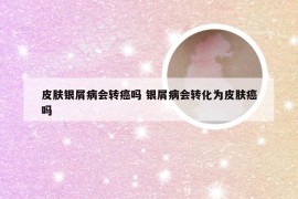 皮肤银屑病会转癌吗 银屑病会转化为皮肤癌吗