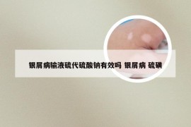 银屑病输液硫代硫酸钠有效吗 银屑病 硫磺