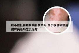 血小板低和银屑病有关系吗 血小板低和银屑病有关系吗怎么治疗