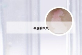 牛皮癣风气