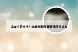 凉血中药治疗牛皮癣有毒吗 银屑病清热凉血