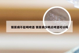 银屑病不能喝啤酒 银屑病少喝点啤酒可以吗