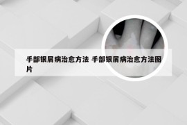 手部银屑病治愈方法 手部银屑病治愈方法图片