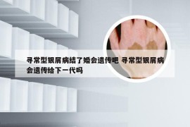 寻常型银屑病结了婚会遗传吧 寻常型银屑病会遗传给下一代吗