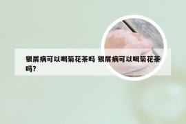 银屑病可以喝菊花茶吗 银屑病可以喝菊花茶吗?
