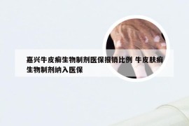 嘉兴牛皮癣生物制剂医保报销比例 牛皮肤癣生物制剂纳入医保
