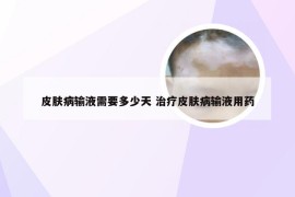 皮肤病输液需要多少天 治疗皮肤病输液用药