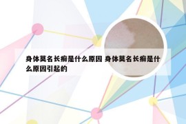身体莫名长癣是什么原因 身体莫名长癣是什么原因引起的