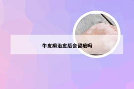 牛皮癣治愈后会留疤吗