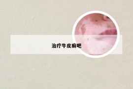 治疗牛皮癣吧