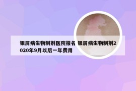 银屑病生物制剂医院报名 银屑病生物制剂2020年9月以后一年费用
