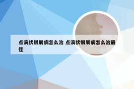 点滴状银屑病怎么治 点滴状银屑病怎么治最佳