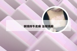 铜钱样牛皮癣 治铜钱癣