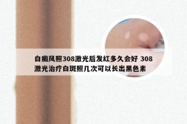 白癜风照308激光后发红多久会好 308激光治疗白斑照几次可以长出黑色素