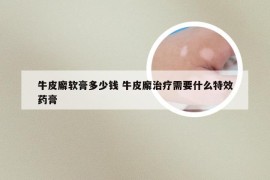 牛皮廨软膏多少钱 牛皮廨治疗需要什么特效药膏