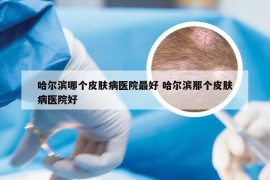 哈尔滨哪个皮肤病医院最好 哈尔滨那个皮肤病医院好