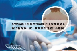 60岁后脸上出现白斑原因 六十岁左右的人脸上有好多一片一片的黑斑这是什么原因