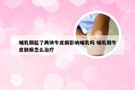 哺乳期起了两块牛皮癣影响哺乳吗 哺乳期牛皮肤癣怎么治疗
