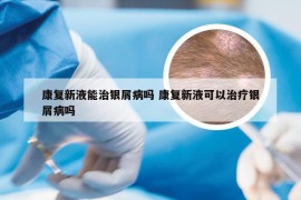康复新液能治银屑病吗 康复新液可以治疗银屑病吗