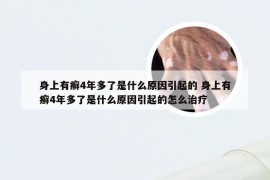 身上有癣4年多了是什么原因引起的 身上有癣4年多了是什么原因引起的怎么治疗