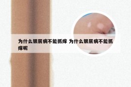 为什么银屑病不能抓痒 为什么银屑病不能抓痒呢