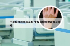 牛皮癣可以喝红花吗 牛皮肤癣能泡藏红花喝吗