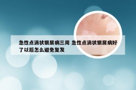 急性点滴状银屑病三周 急性点滴状银屑病好了以后怎么避免复发