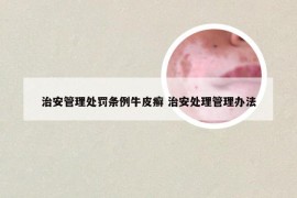 治安管理处罚条例牛皮癣 治安处理管理办法