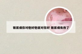 银屑病你对他好他就对你好 银屑病有救了