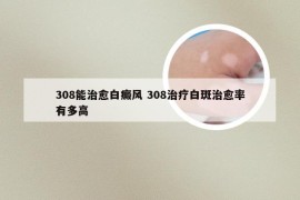 308能治愈白癜风 308治疗白斑治愈率有多高