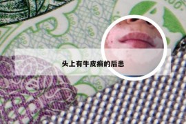 头上有牛皮癣的后患
