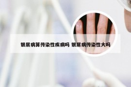 银屑病算传染性疾病吗 银屑病传染性大吗