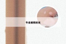 牛皮癣照的光