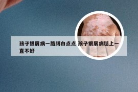 孩子银屑病一胳膊白点点 孩子银屑病腿上一直不好
