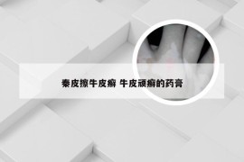 秦皮擦牛皮癣 牛皮顽癣的药膏